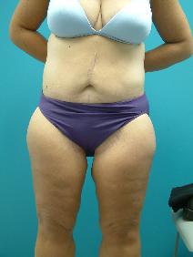 Body Contouring After Photo by Deborah Sillins, MD; Hebron, KY - Case 7149