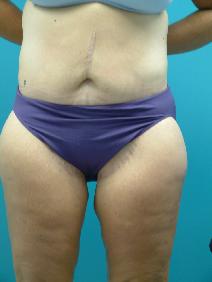 Body Contouring After Photo by Deborah Sillins, MD; Hebron, KY - Case 7150