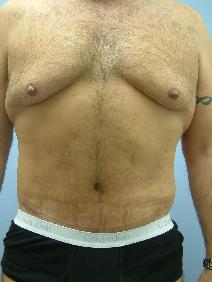 Tummy Tuck After Photo by Deborah Sillins, MD; Hebron, KY - Case 9014