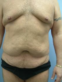 Tummy Tuck Before Photo by Deborah Sillins, MD; Hebron, KY - Case 9014