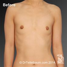 Breast Augmentation Before Photo by Steven Teitelbaum, MD; Santa Monica, CA - Case 27812