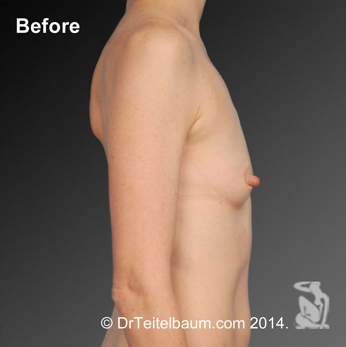 Breast Augmentation Before and After Photos by Steven Teitelbaum