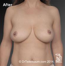 Breast Reduction After Photo by Steven Teitelbaum, MD; Santa Monica, CA - Case 27822