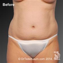 Tummy Tuck Before Photo by Steven Teitelbaum, MD; Santa Monica, CA - Case 28099