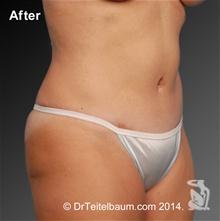 Tummy Tuck After Photo by Steven Teitelbaum, MD; Santa Monica, CA - Case 28099