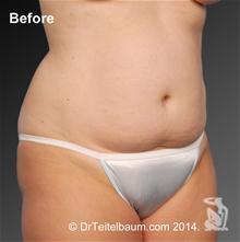 Tummy Tuck Before Photo by Steven Teitelbaum, MD; Santa Monica, CA - Case 28099