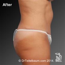 Tummy Tuck After Photo by Steven Teitelbaum, MD; Santa Monica, CA - Case 28099