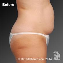 Tummy Tuck Before Photo by Steven Teitelbaum, MD; Santa Monica, CA - Case 28099
