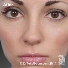 Rhinoplasty After Photo by Steven Teitelbaum, MD; Santa Monica, CA - Case 28106