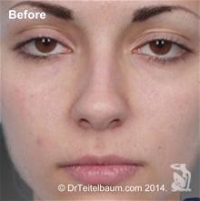 Rhinoplasty Before Photo by Steven Teitelbaum, MD; Santa Monica, CA - Case 28106