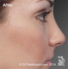 Rhinoplasty After Photo by Steven Teitelbaum, MD; Santa Monica, CA - Case 28106