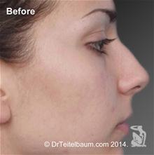 Rhinoplasty Before Photo by Steven Teitelbaum, MD; Santa Monica, CA - Case 28106