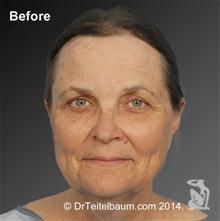 Facelift Before Photo by Steven Teitelbaum, MD; Santa Monica, CA - Case 28108