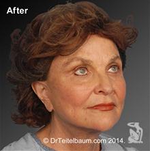 Facelift After Photo by Steven Teitelbaum, MD; Santa Monica, CA - Case 28108