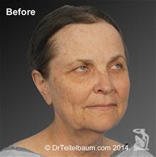 Facelift Before Photo by Steven Teitelbaum, MD; Santa Monica, CA - Case 28108