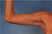 Arm Lift After Photo by Kent Hasen, MD; Naples, FL - Case 30692