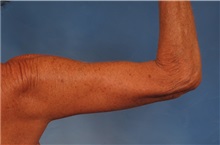 Arm Lift After Photo by Kent Hasen, MD; Naples, FL - Case 30692