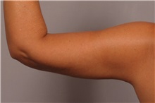 Arm Lift After Photo by Kent Hasen, MD; Naples, FL - Case 30693
