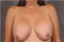 Breast Implant Removal Before Photo by Kent Hasen, MD; Naples, FL - Case 30694