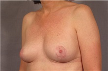 Breast Implant Removal After Photo by Kent Hasen, MD; Naples, FL - Case 30694