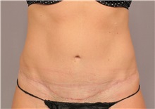 Tummy Tuck After Photo by Kent Hasen, MD; Naples, FL - Case 30695