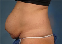 Tummy Tuck Before Photo by Kent Hasen, MD; Naples, FL - Case 30695
