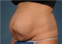 Tummy Tuck Before Photo by Kent Hasen, MD; Naples, FL - Case 30695