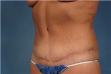 Tummy Tuck After Photo by Kent Hasen, MD; Naples, FL - Case 30696