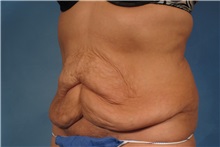 Tummy Tuck Before Photo by Kent Hasen, MD; Naples, FL - Case 30696