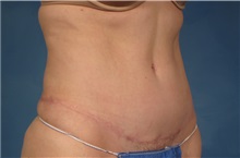 Tummy Tuck After Photo by Kent Hasen, MD; Naples, FL - Case 30697