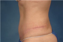 Tummy Tuck After Photo by Kent Hasen, MD; Naples, FL - Case 30697