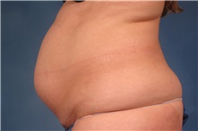 Tummy Tuck Before Photo by Kent Hasen, MD; Naples, FL - Case 30697
