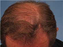 Hair Transplant After Photo by Kent Hasen, MD; Naples, FL - Case 30698