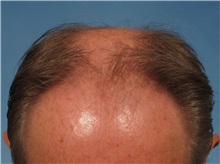 Hair Transplant Before Photo by Kent Hasen, MD; Naples, FL - Case 30698