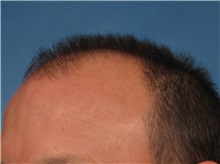 Hair Transplant Before Photo by Kent Hasen, MD; Naples, FL - Case 30699