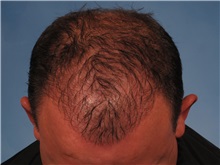 Hair Transplant After Photo by Kent Hasen, MD; Naples, FL - Case 30699