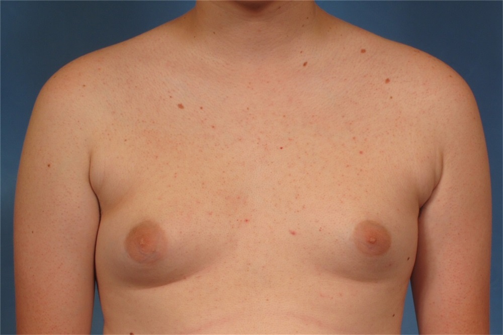 Opting For Smaller Breasts - Naples Cosmetic Surgery Center