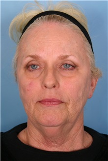 Facelift Before Photo by Kent Hasen, MD; Naples, FL - Case 30702
