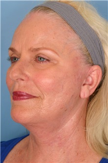 Facelift After Photo by Kent Hasen, MD; Naples, FL - Case 30702