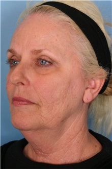 Facelift Before Photo by Kent Hasen, MD; Naples, FL - Case 30702