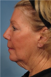 Facelift Before Photo by Kent Hasen, MD; Naples, FL - Case 30703