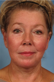 Facelift After Photo by Kent Hasen, MD; Naples, FL - Case 30703