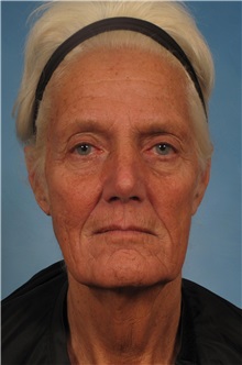 Facelift Before Photo by Kent Hasen, MD; Naples, FL - Case 30704