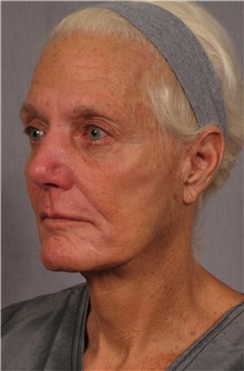 Facelift After Photo by Kent Hasen, MD; Naples, FL - Case 30704