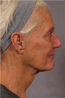 Facelift After Photo by Kent Hasen, MD; Naples, FL - Case 30704