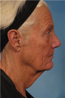 Facelift Before Photo by Kent Hasen, MD; Naples, FL - Case 30704