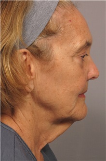 Facelift Before Photo by Kent Hasen, MD; Naples, FL - Case 30705