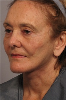 Facelift After Photo by Kent Hasen, MD; Naples, FL - Case 30705