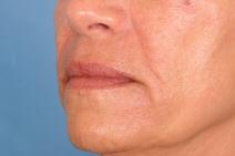 Dermal Fillers Before Photo by Kent Hasen, MD; Naples, FL - Case 6851