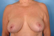 Breast Reduction After Photo by Kent Hasen, MD; Naples, FL - Case 6852